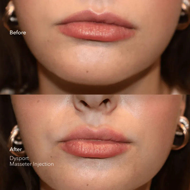 Neurotoxin BeforeAfter_Dysport (2)