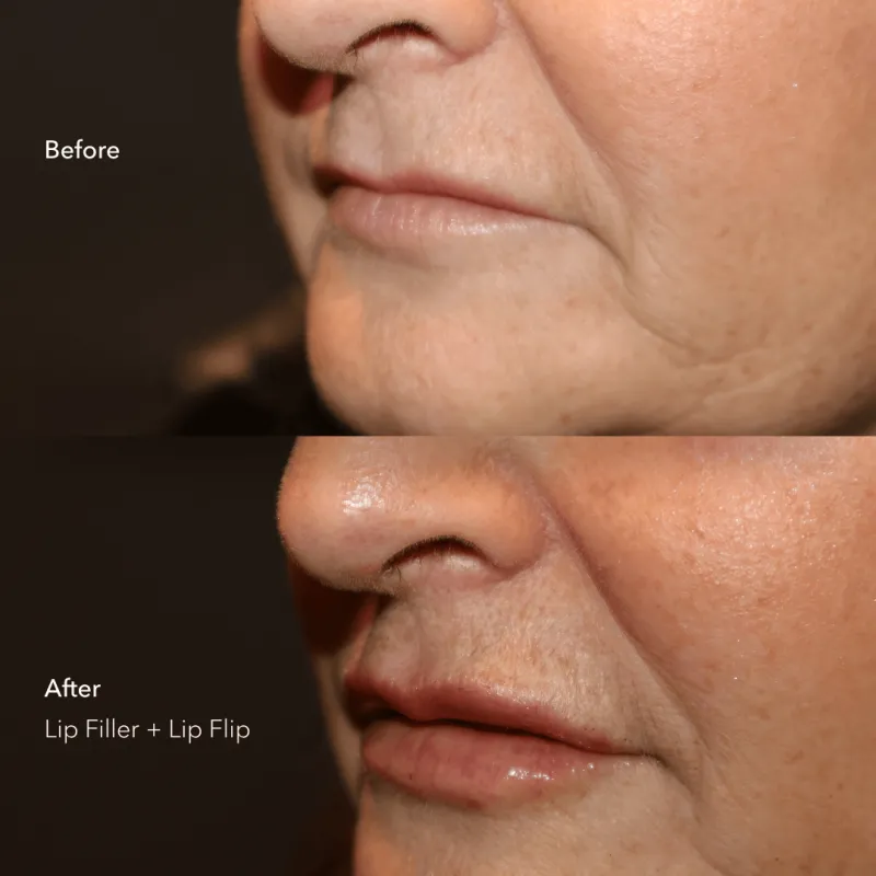 Dermal Lip Filler & Lip Flip_BeforeAfter (2)