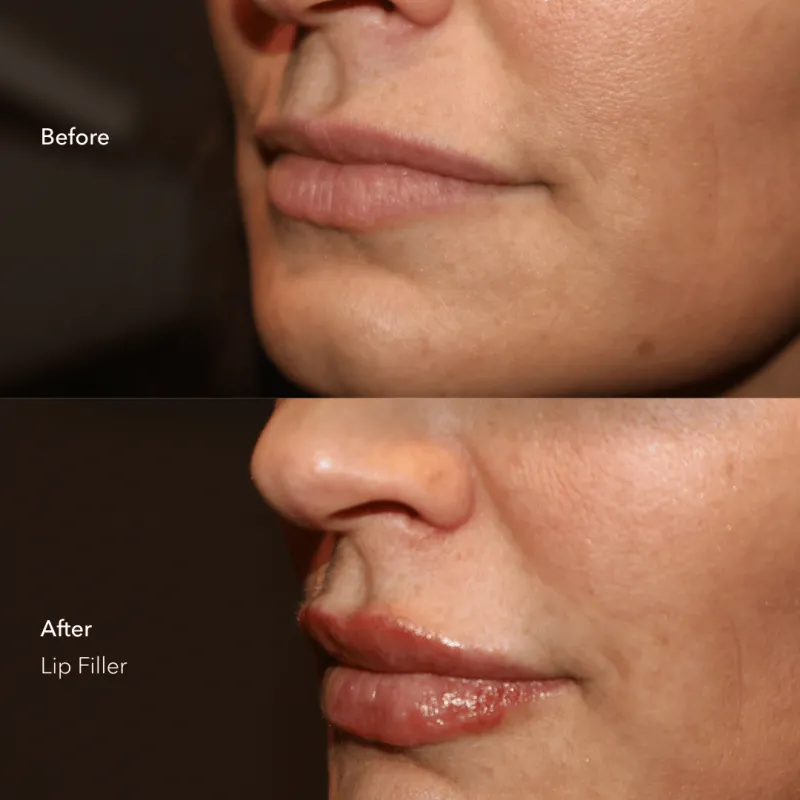 Dermal Lip Filler_BeforeAfter (2)